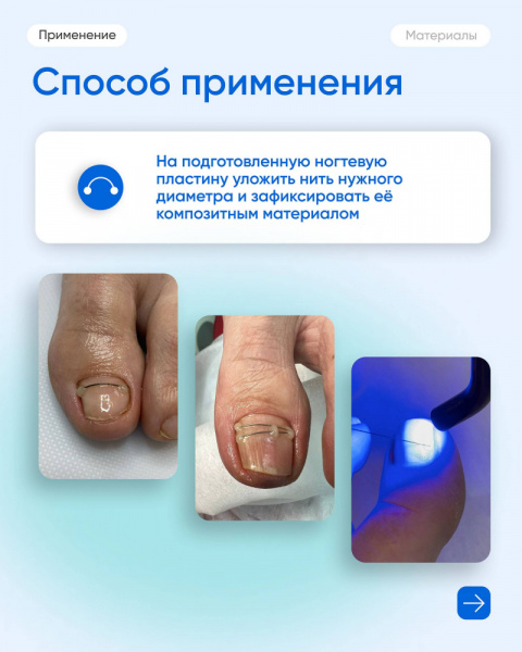 Подолджест титановая нить №14 (5 штук)